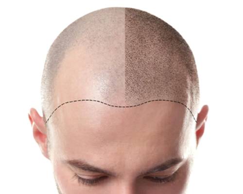 Tricopigmentation schéma avant-après