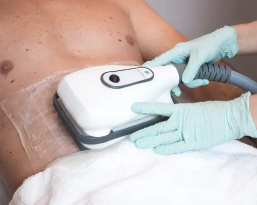 cryolipolyse de cooltech