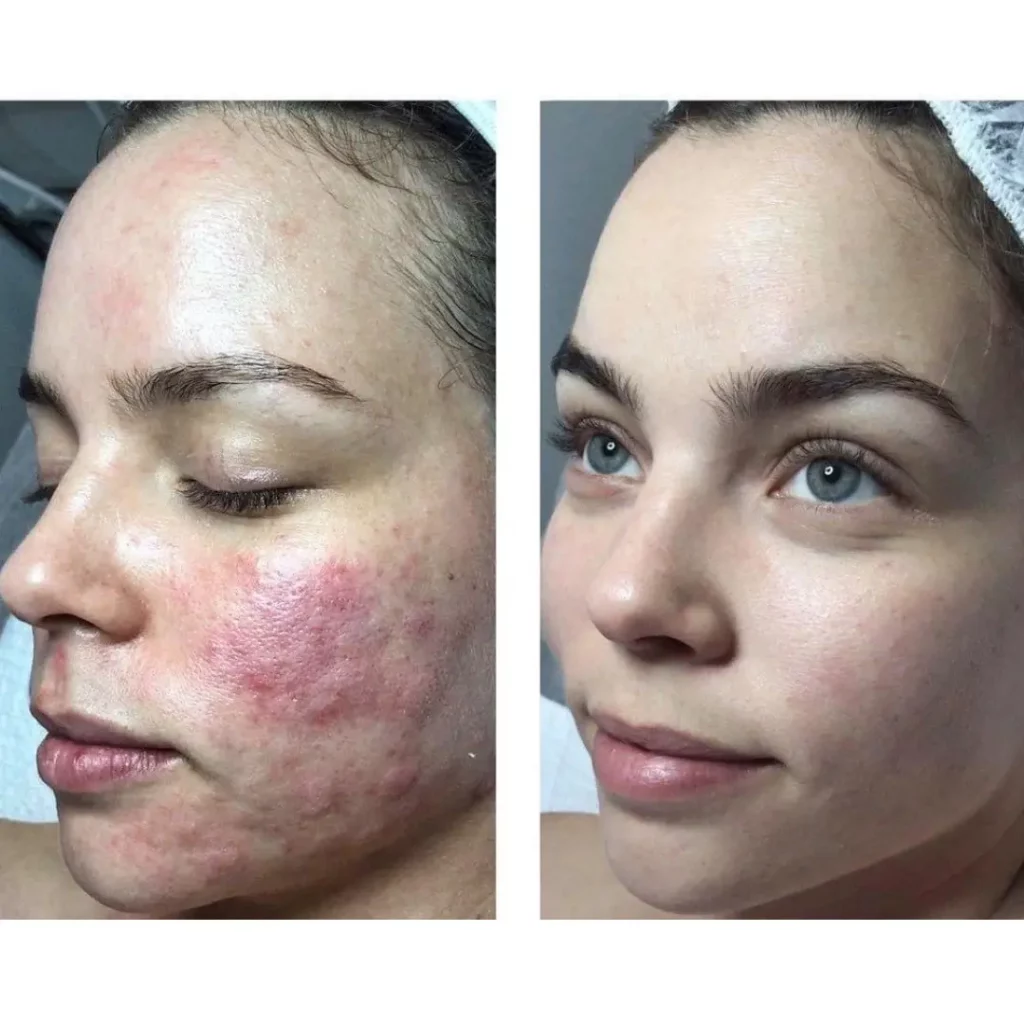microneedling Avant-Après chez ACB institut de beauté bien-être