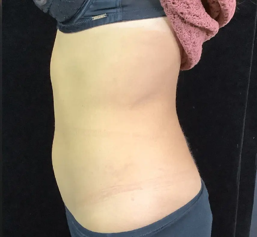 Abdomen après Cryolipolyse