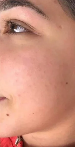Résultat après JetPeel sur visage