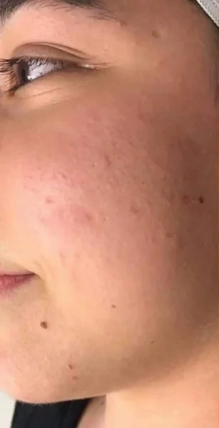 JetPeel avant