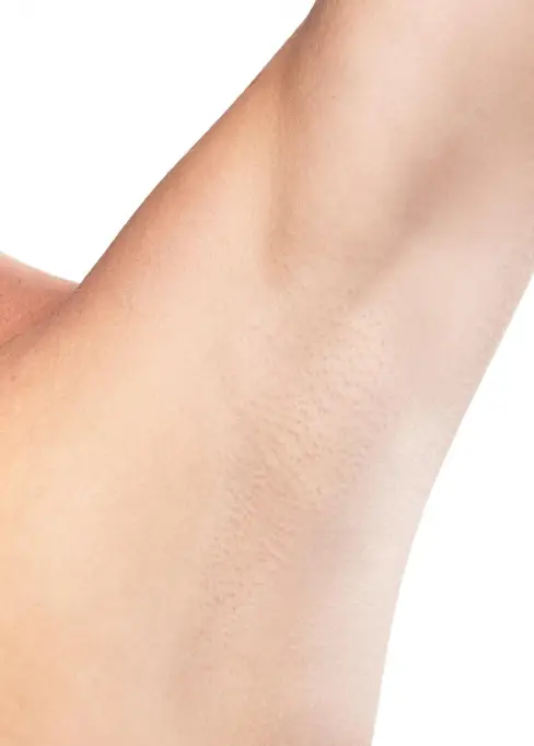 aisselles de femme avant épilation laser