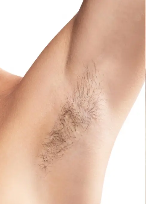 aisselles de femme avant épilation laser