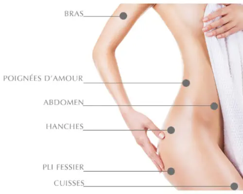 Zones de traitement de la cryolipolyse