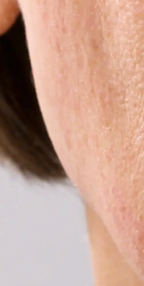 dermaplaning Après: disparition du duvet de la zone mandibule inférieure droite