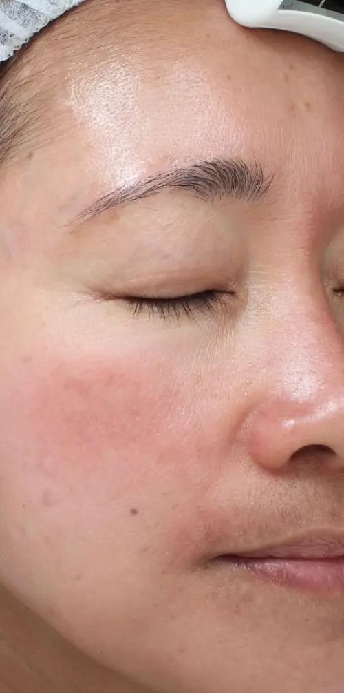 visage après BBGlow