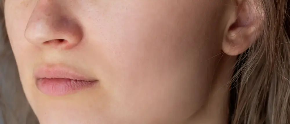 Photomodulation LED acné Après
