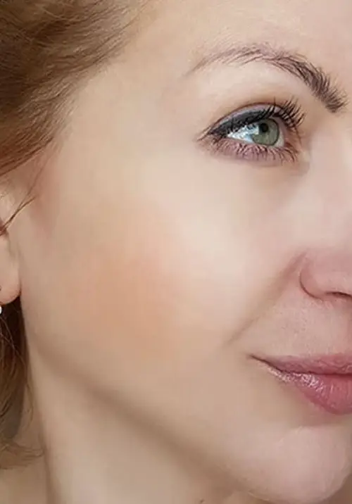 Photomodulation LED rides visage Après