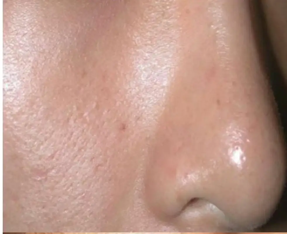 carbon peel pores Après