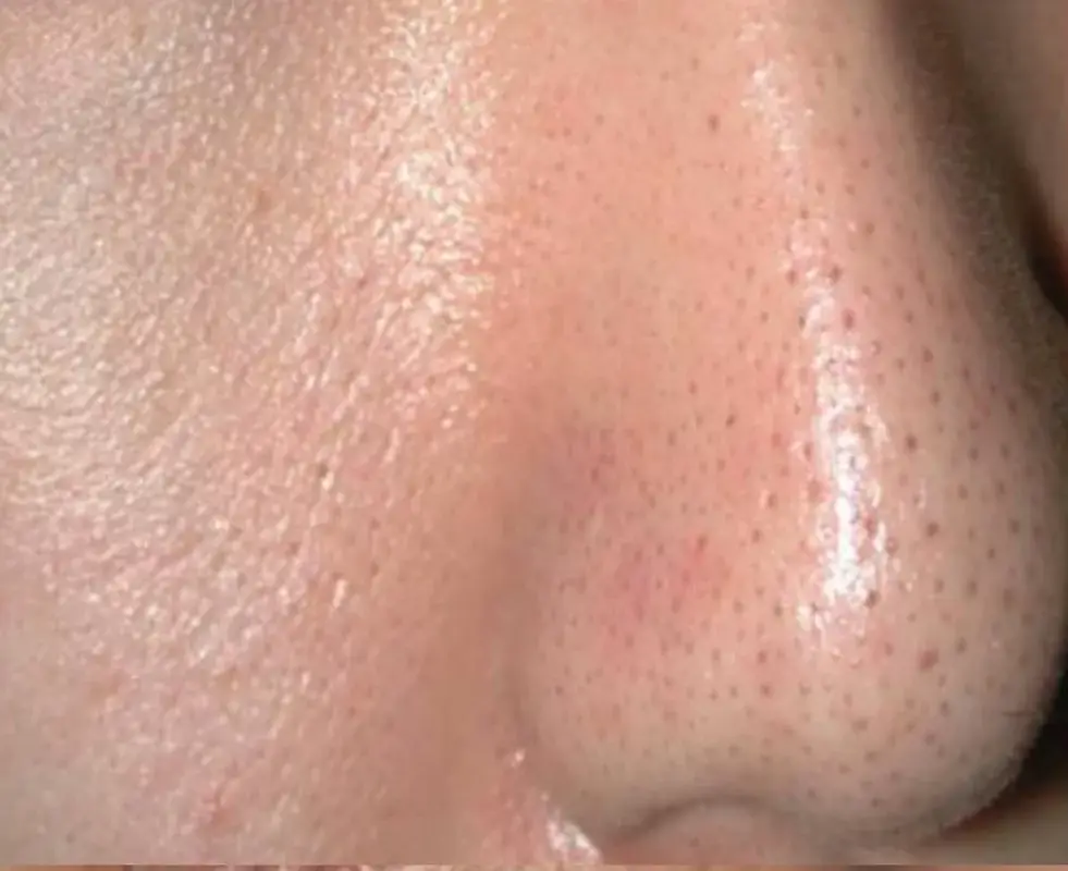 carbon peel pores Avant