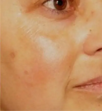 carbon peel taches après