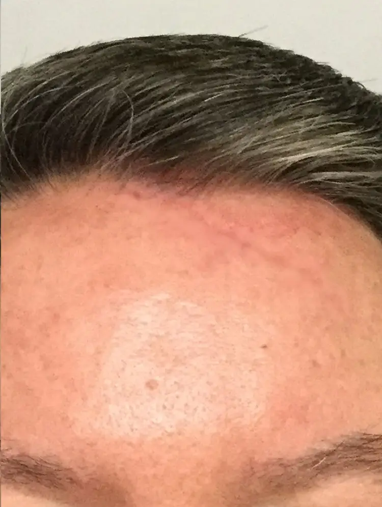 dermopigmentation cicatrice après
