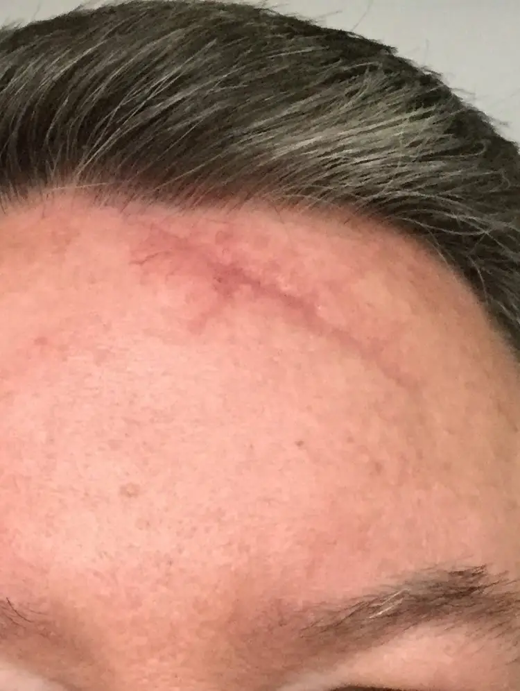 dermopigmentation cicatrice avant