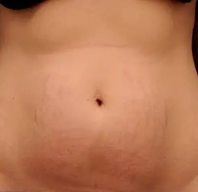 dermopigmentation vergetures après