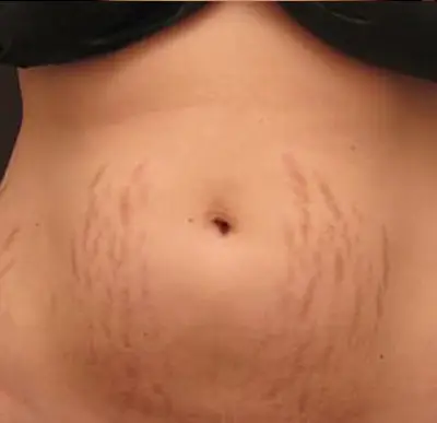 dermopigmentation vergetures avant