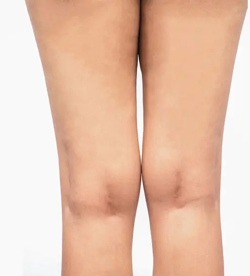 lipocavitation & radiofréquence des cuisses - Après