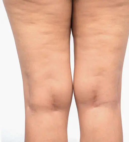 lipocavitation & radiofréquence des cuisses - Avant 