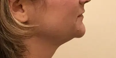 lipocavitation & radiofréquence menton Après