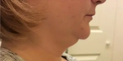 lipocavitation & radiofréquence menton Avant