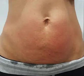 lipocavitation & radiofréquence ventre Après