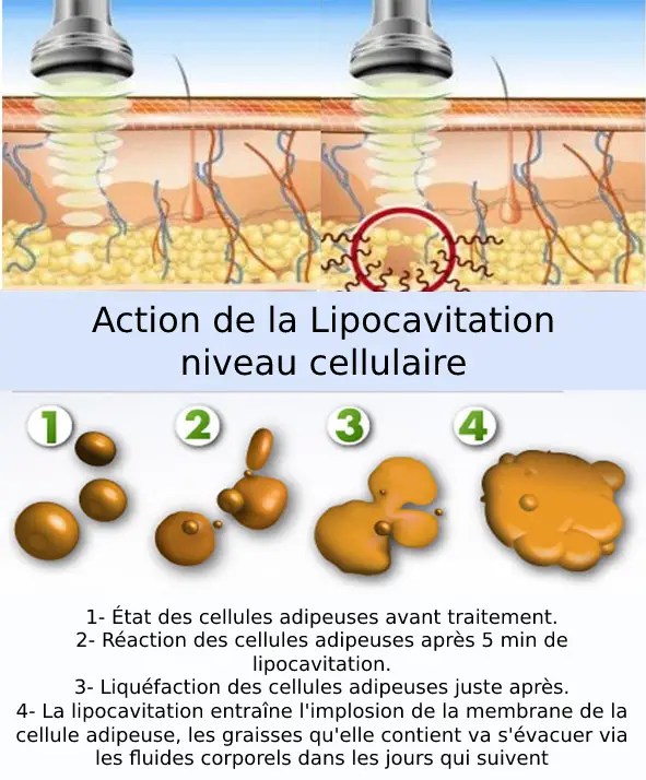 lipocavitation : comment ça marche?