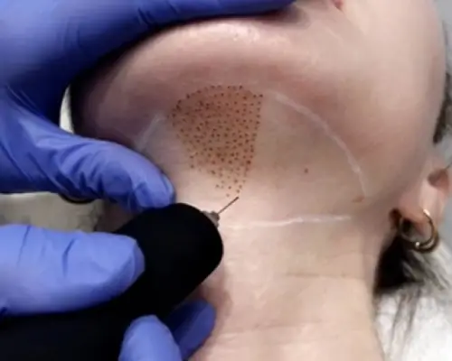 Skin lift cou