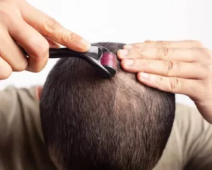 Tricorigen_cheveux