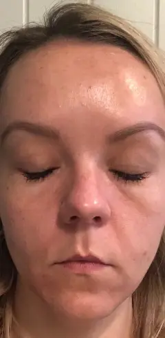 peeling après