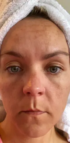 peeling avant