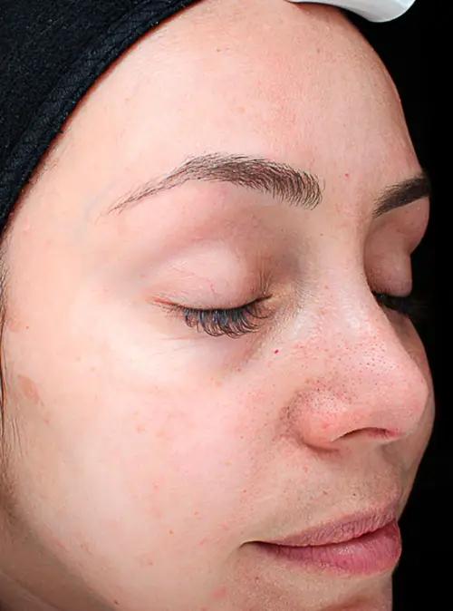peeling peau acnéique après
