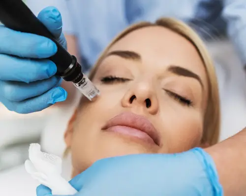 microneedling process