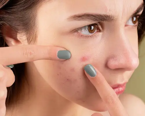 soins pour traiter l'acné