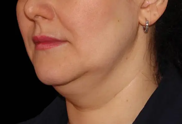 État du menton avant la cryolipolyse