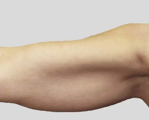 État du bras avant la cryolipolyse