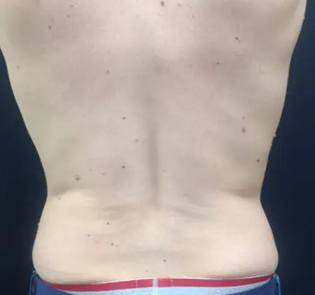 État de la graisse dorsale après la cryolipolyse