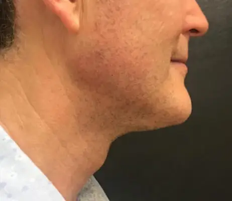 État du menton après la cryolipolyse