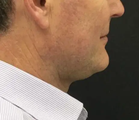 État du menton avant la cryolipolyse