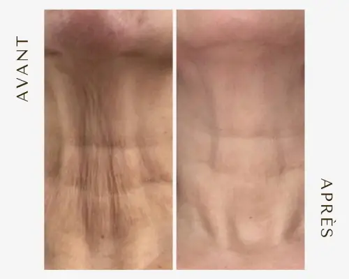 Skin lift les résultats avant-après
