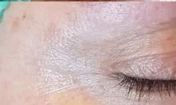 Skinlift Après #2: lifting pâtes d'oie