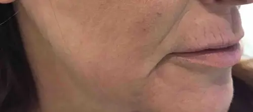 Skinlift Après #3: zone des bajoues
