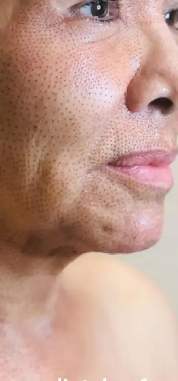 Skinlift Après #4: lifting visage