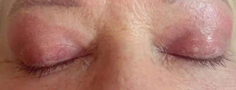 Skinlift Après#1