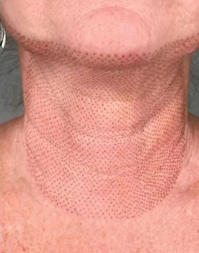Skinlift Après: zone du cou #5