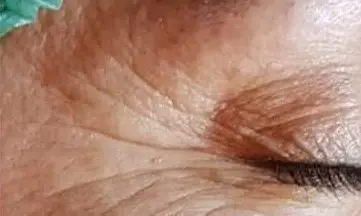 Skinlift Avant #2: lifting pâtes d'oie