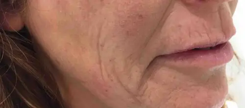 Skinlift Avant #3: zone des bajoues