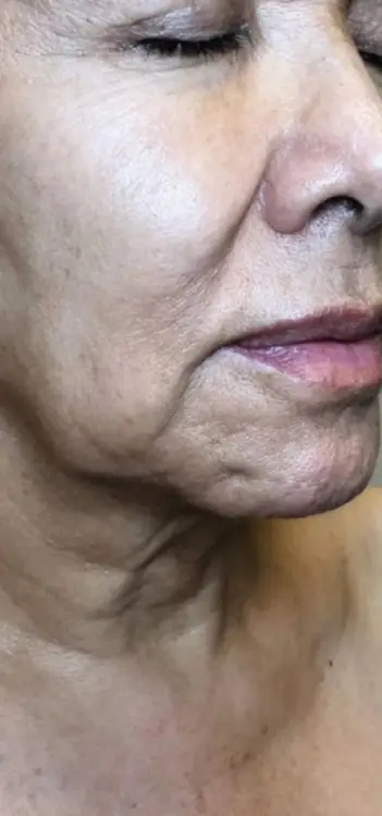 Skinlift Avant #4: lifting visage
