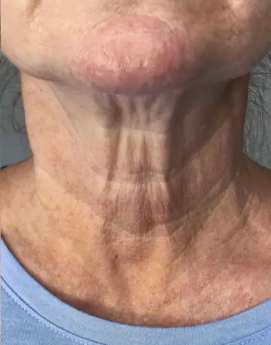 Skinlift Avant#5