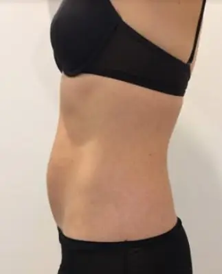 État du ventre avant la cryolipolyse