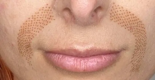 Disparition des rides de la bouche après le skinlift